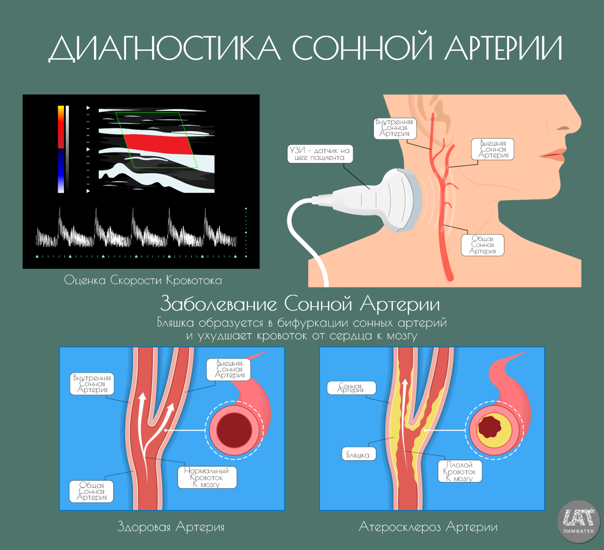 Причины сужения сосудов головного. Атеросклероз брахиоцефальных артерий со стенозом. Атеросклеротическая бляшка в сонной артерии. Атеросклеротическое сужение сосудов.